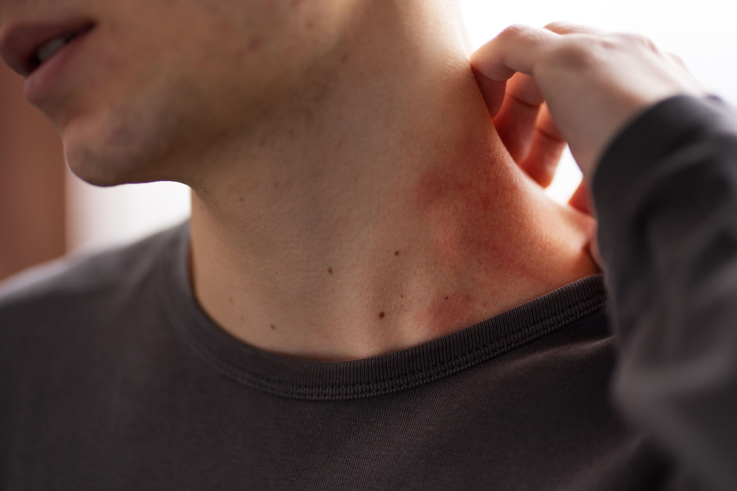 Alergia ao frio realmente existe? Saiba como descobrir se você tem (e quando ir ao médico)